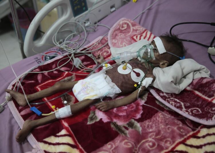 In this Nov. 3, 2020, file photo, malnourished girl, Rahmah Watheeq, receiving treatment at a feeding center at Al-Sabeen hospital in Sanaa, Yemen. Countries like Lebanon, Syria, Iraq, Lebanon and Yemen are all teetering on the brink of humanitarian catastrophe with an economic implosion that threatens to throw the region into even deeper turmoil.