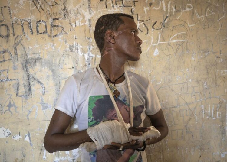 UN report says Ethiopia's war marked by 'extreme brutality' 1 - Egyptian Gazette FILE - Ethnic Tigrayan survivor Abrahaley Minasbo, 22, from Mai-Kadra, Ethiopia, shows wounds from machetes he says were inflicted by a pro-government militia on Nov. 9, inside a shelter in Hamdeyat Transition Center near the Sudan-Ethiopia border, in eastern Sudan on Dec. 15, 2020. A year after war began there, the findings of the only human rights investigation allowed in Ethiopia's blockaded Tigray region will be released Wednesday, Nov. 3, 2021.