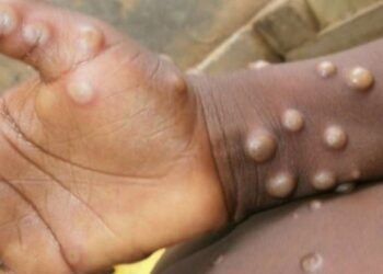 WHO “not concerned” about monkeypox becoming pandemic