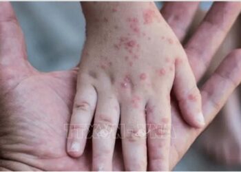 `More than 550 confirmed cases of monkeypox in 30 countries`
