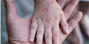 `More than 550 confirmed cases of monkeypox in 30 countries`