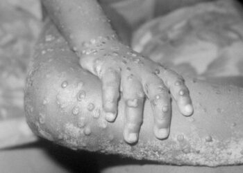 3 probable cases of monkeypox reported in Tennessee