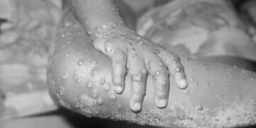 3 probable cases of monkeypox reported in Tennessee