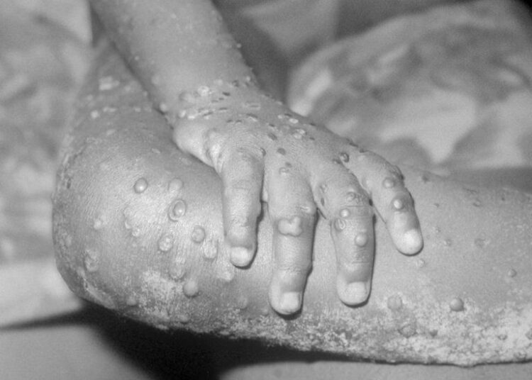 3 probable cases of monkeypox reported in Tennessee 1 - Egyptian Gazette