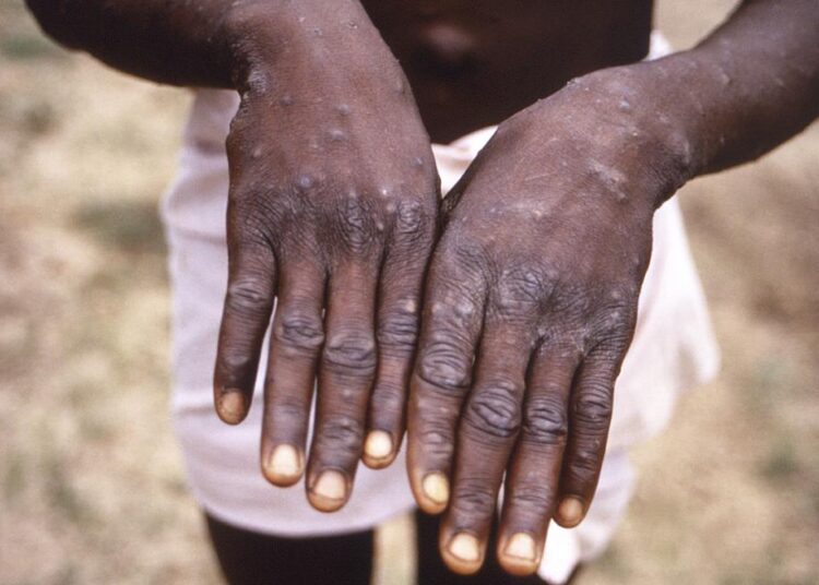 FILE - This 1997 image provided by the CDC during an investigation into an outbreak of monkeypox, which took place in the Democratic Republic of the Congo (DRC), formerly Zaire, and depicts the dorsal surfaces of the hands of a monkeypox case patient, who was displaying the appearance of the characteristic rash during its recuperative stage. The World Health Organisation is convening its emergency committee on Thursday, July 21, 2022 to consider for the second time within weeks whether the expanding outbreak of monkeypox should be declared a global crisis.