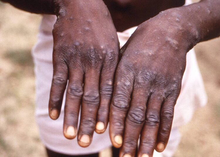 Dorsal surfaces of the hands of a monkeypox patient, showing a rash during the recuperative stage
