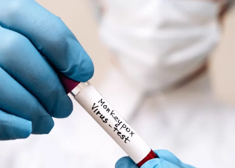 Monkeypox reaches all 50 states in US 1 - Egyptian Gazette