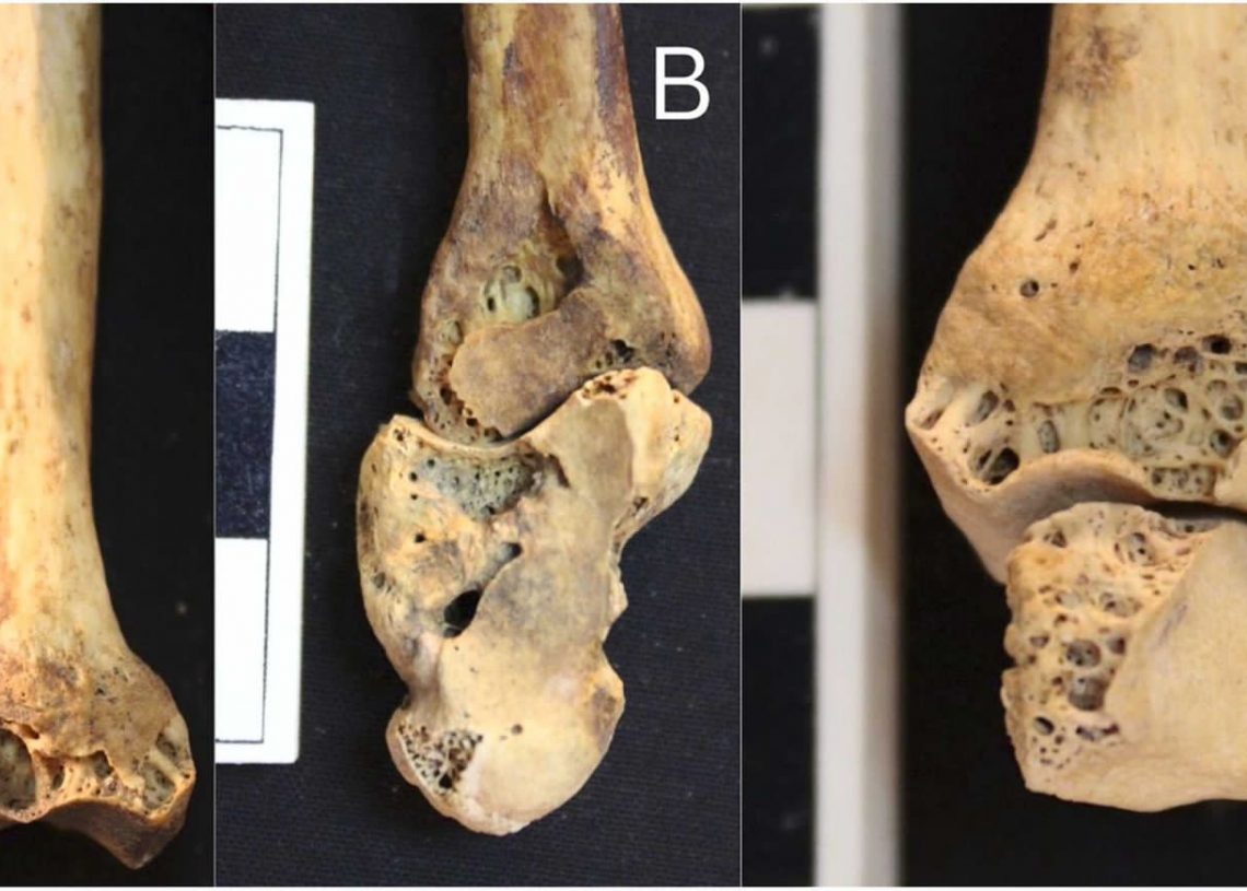 Oldest case of rheumatoid arthritis in ancient Egypt unveiled 11 - Egyptian Gazette
