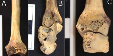 Oldest case of rheumatoid arthritis in ancient Egypt unveiled