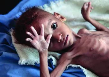 UNICEF: 77m children, adolescents have some form of malnutrition in MENA