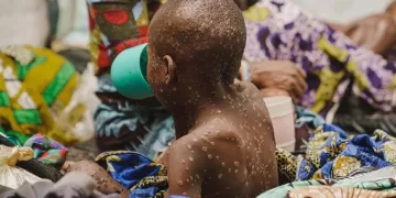 WHO expresses concern over rapid spread of monkeypox virus