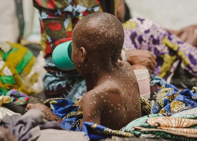 WHO expresses concern over rapid spread of monkeypox virus 1 - Egyptian Gazette