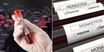 Malaysia records 1st monkeypox case in 2024 1 - Egyptian Gazette Malaysia records 1st monkeypox case in 2024