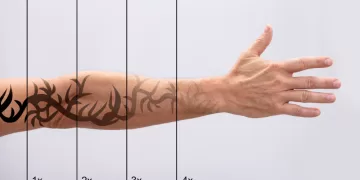 Tattoo Removal