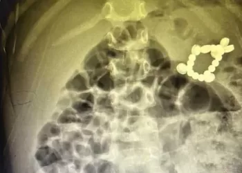 Egyptian child survives swallowing 20 batteries, magnets