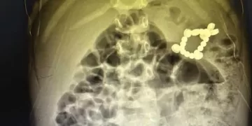 Egyptian child survives swallowing 20 batteries, magnets