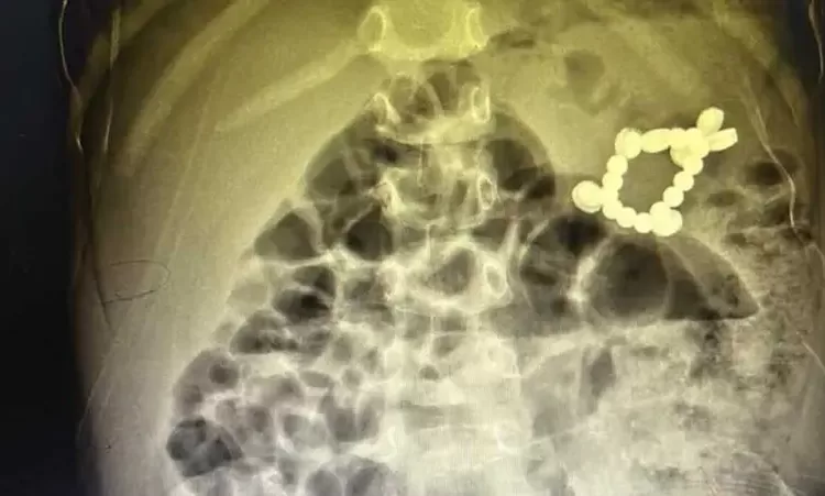 Egyptian child survives swallowing 20 batteries, magnets 11 - Egyptian Gazette