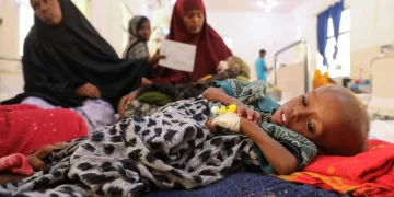 MSF: Half of displaced Somali children acutely malnourished 1 - Egyptian Gazette MSF: Half of displaced Somali children acutely malnourished